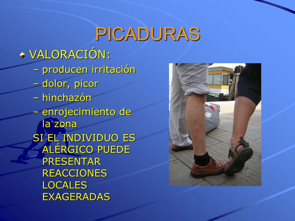 PICADURAS VALORACIÓN: producen irritación dolor, picor hinchazón