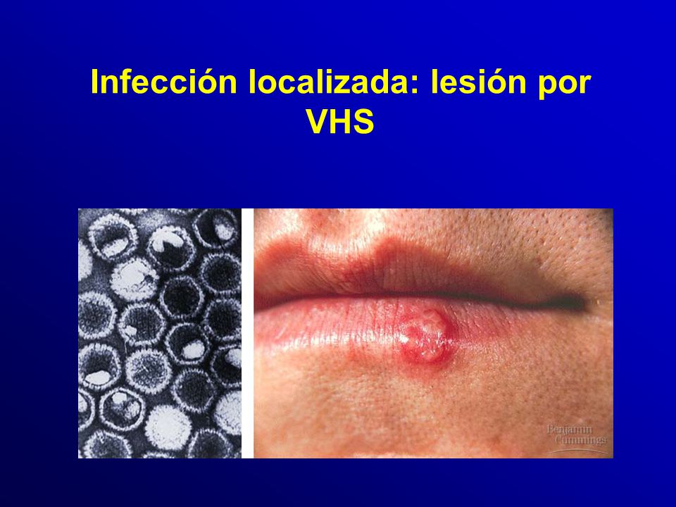 Infección localizada: lesión por VHS
