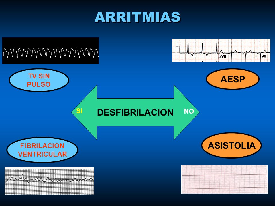 ARRITMIAS AESP DESFIBRILACION ASISTOLIA TV SIN PULSO SI NO FIBRILACION