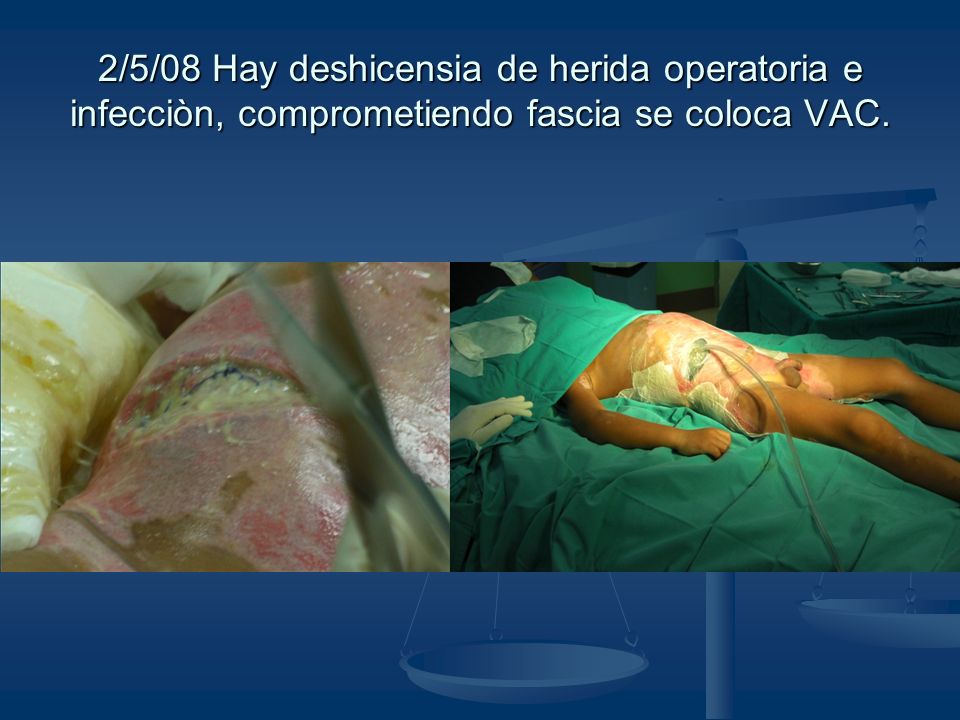 2/5/08 Hay deshicensia de herida operatoria e infecciòn, comprometiendo fascia se coloca VAC.