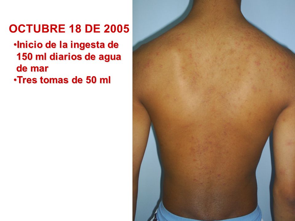 OCTUBRE 18 DE 2005 Inicio de la ingesta de 150 ml diarios de agua