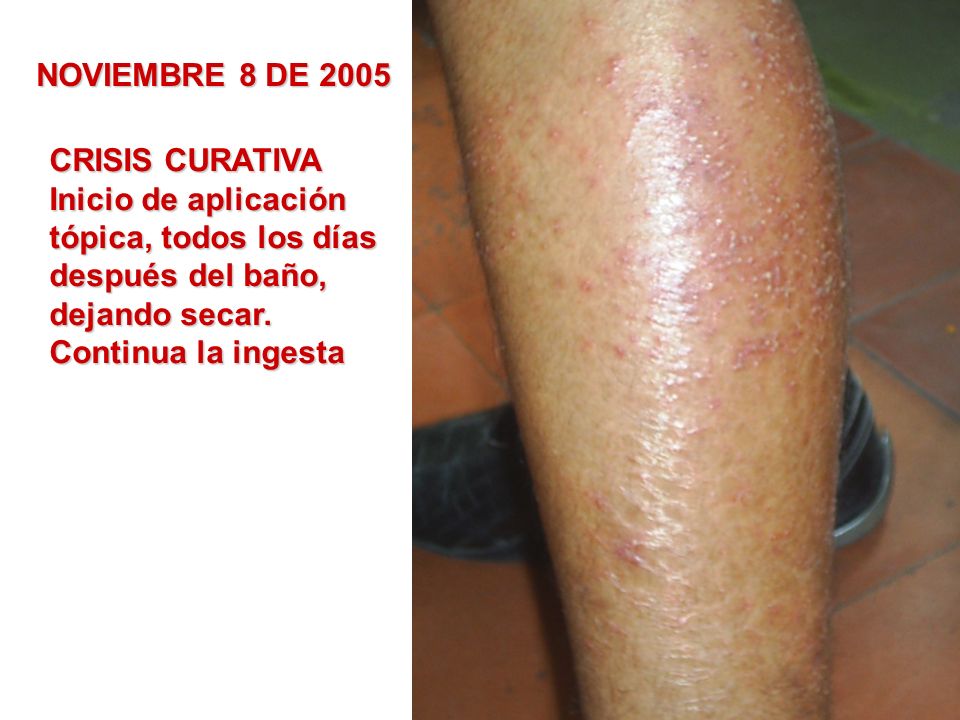 NOVIEMBRE 8 DE 2005 CRISIS CURATIVA. Inicio de aplicación. tópica, todos los días. después del baño,