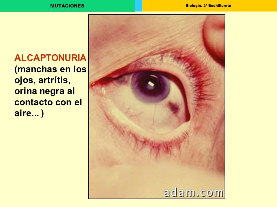 ALCAPTONURIA (manchas en los ojos, artrítis, orina negra al contacto con el aire... )