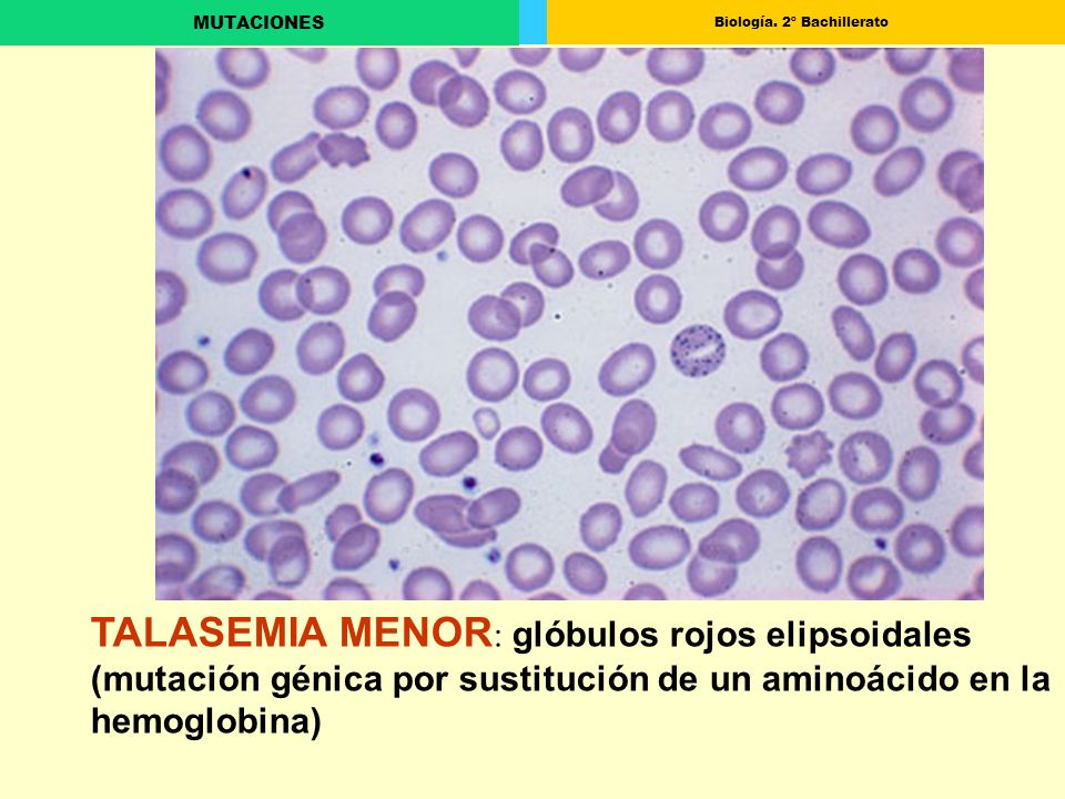 TALASEMIA MENOR: glóbulos rojos elipsoidales (mutación génica por sustitución de un aminoácido en la hemoglobina)