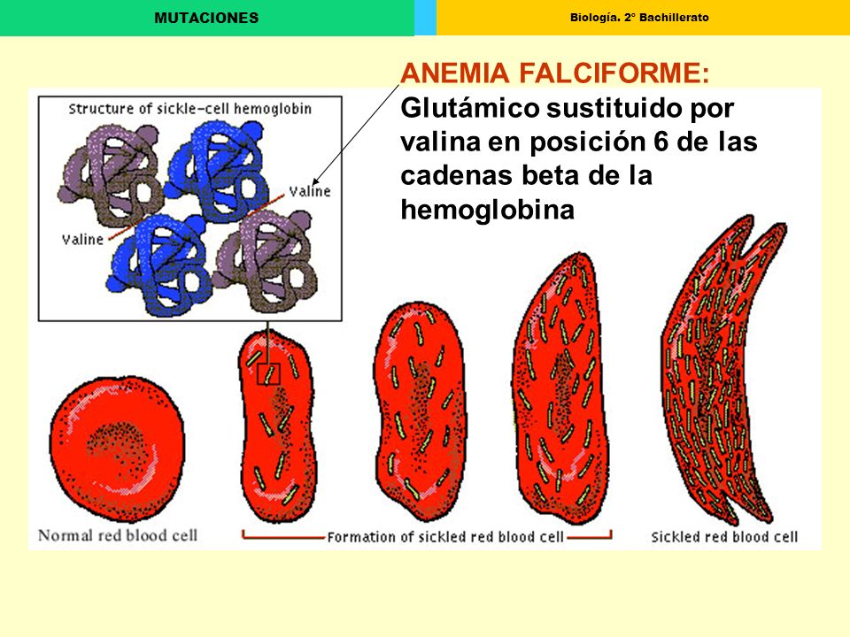 ANEMIA FALCIFORME: Glutámico sustituido por valina en posición 6 de las cadenas beta de la hemoglobina