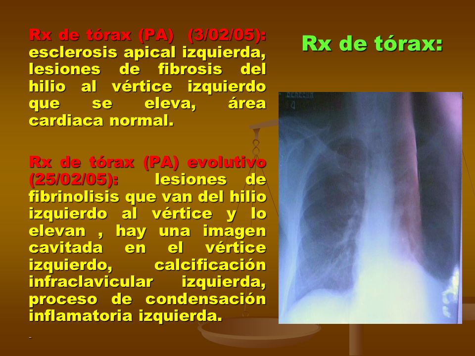 Rx de tórax (PA) (3/02/05): esclerosis apical izquierda, lesiones de fibrosis del hilio al vértice izquierdo que se eleva, área cardiaca normal.