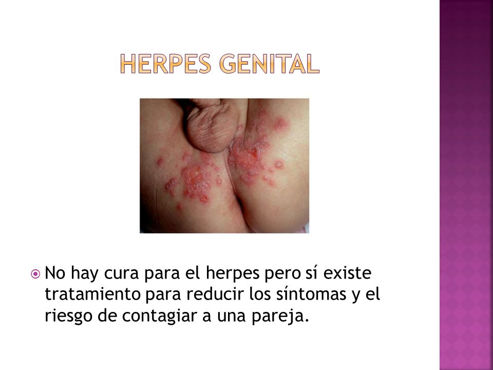 HERPES GENITAL No hay cura para el herpes pero sí existe tratamiento para reducir los síntomas y el riesgo de contagiar a una pareja.
