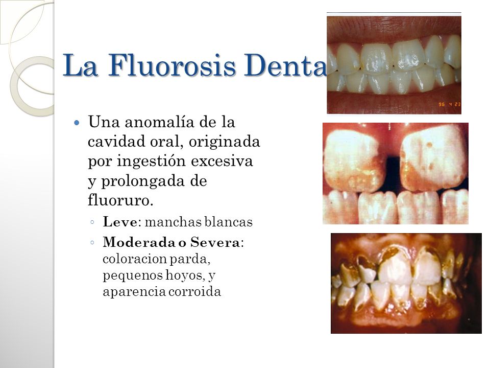 La Fluorosis Dental Una anomalía de la cavidad oral, originada por ingestión excesiva y prolongada de fluoruro.