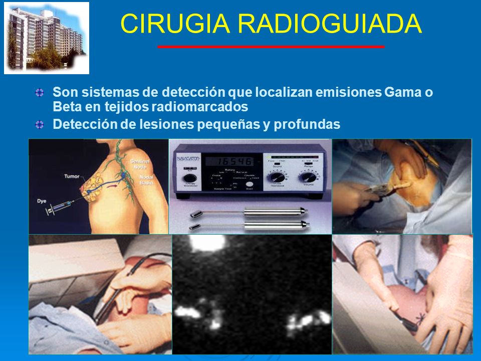 CIRUGIA RADIOGUIADA Son sistemas de detección que localizan emisiones Gama o Beta en tejidos radiomarcados.