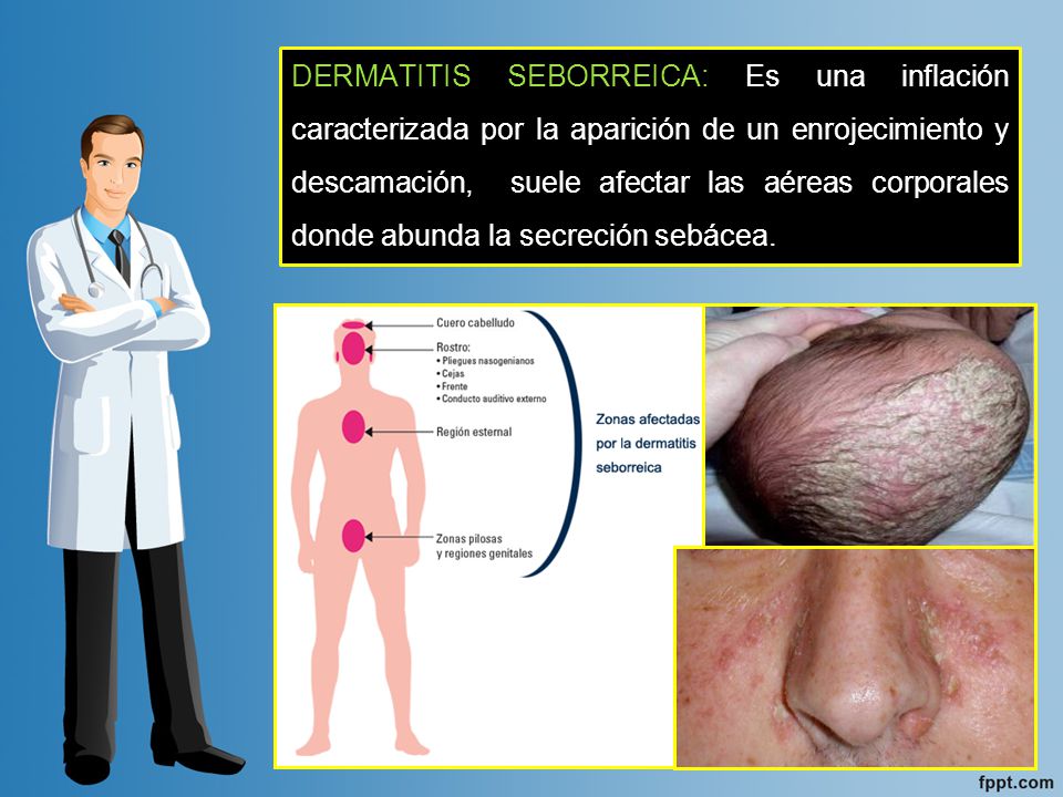 DERMATITIS SEBORREICA: Es una inflación caracterizada por la aparición de un enrojecimiento y descamación, suele afectar las aéreas corporales donde abunda la secreción sebácea.
