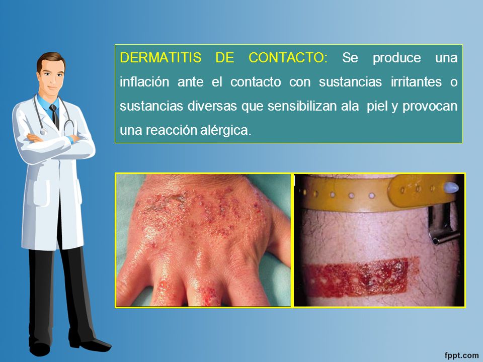 DERMATITIS DE CONTACTO: Se produce una inflación ante el contacto con sustancias irritantes o sustancias diversas que sensibilizan ala piel y provocan una reacción alérgica.