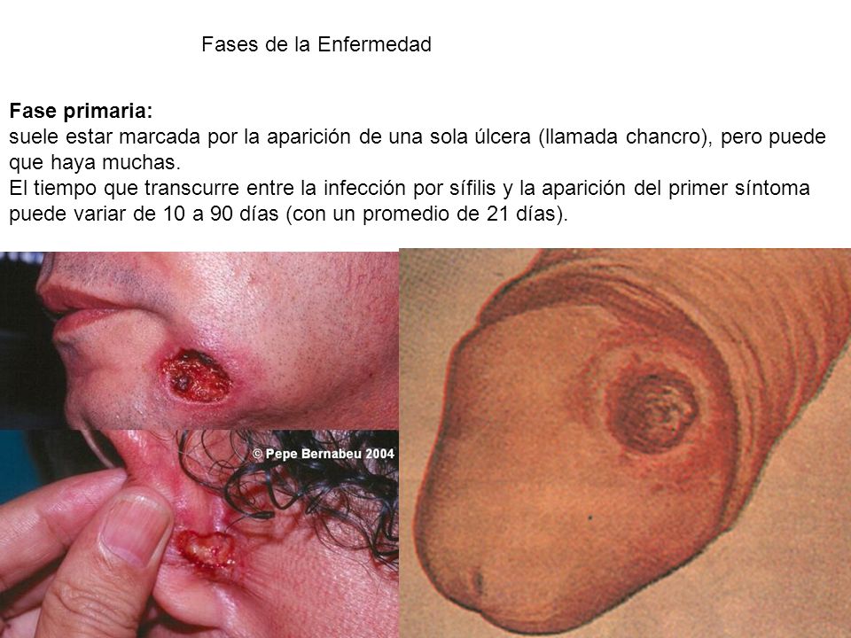 Fases de la Enfermedad Fase primaria: suele estar marcada por la aparición de una sola úlcera (llamada chancro), pero puede que haya muchas.