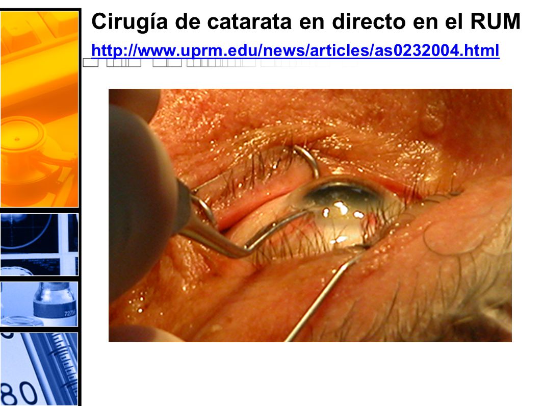 Cirugía de catarata en directo en el RUM   uprm