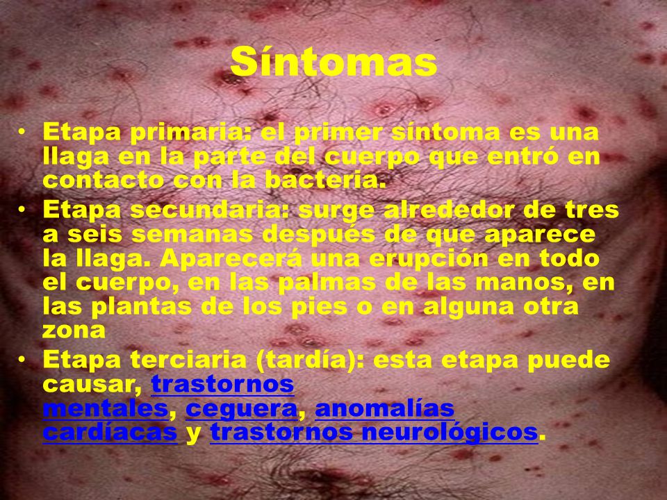 Síntomas Etapa primaria: el primer síntoma es una llaga en la parte del cuerpo que entró en contacto con la bacteria.