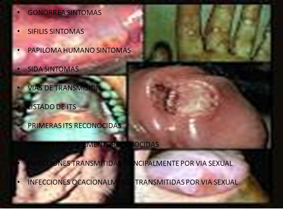 GONORREA SINTOMAS SIFILIS SINTOMAS. PAPILOMA HUMANO SINTOMAS. SIDA SINTOMAS. VIAS DE TRANSMISION.