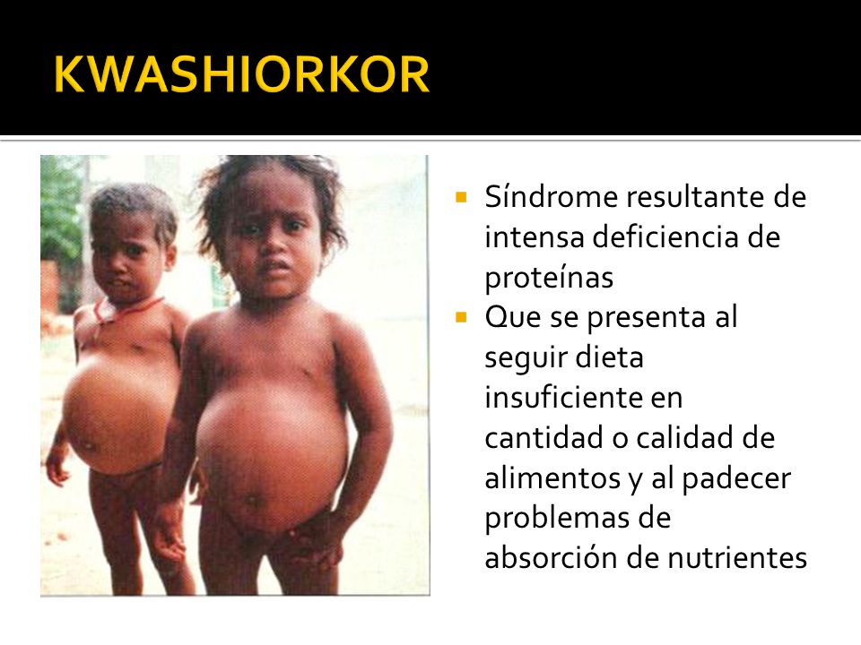 KWASHIORKOR Síndrome resultante de intensa deficiencia de proteínas