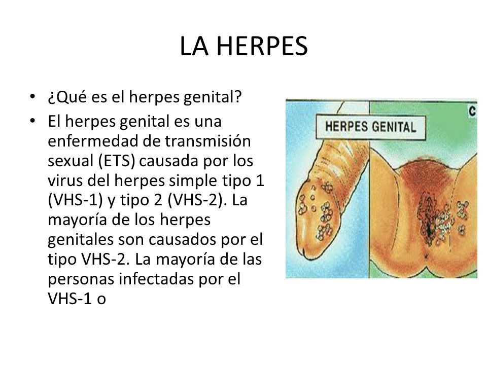 LA HERPES ¿Qué es el herpes genital