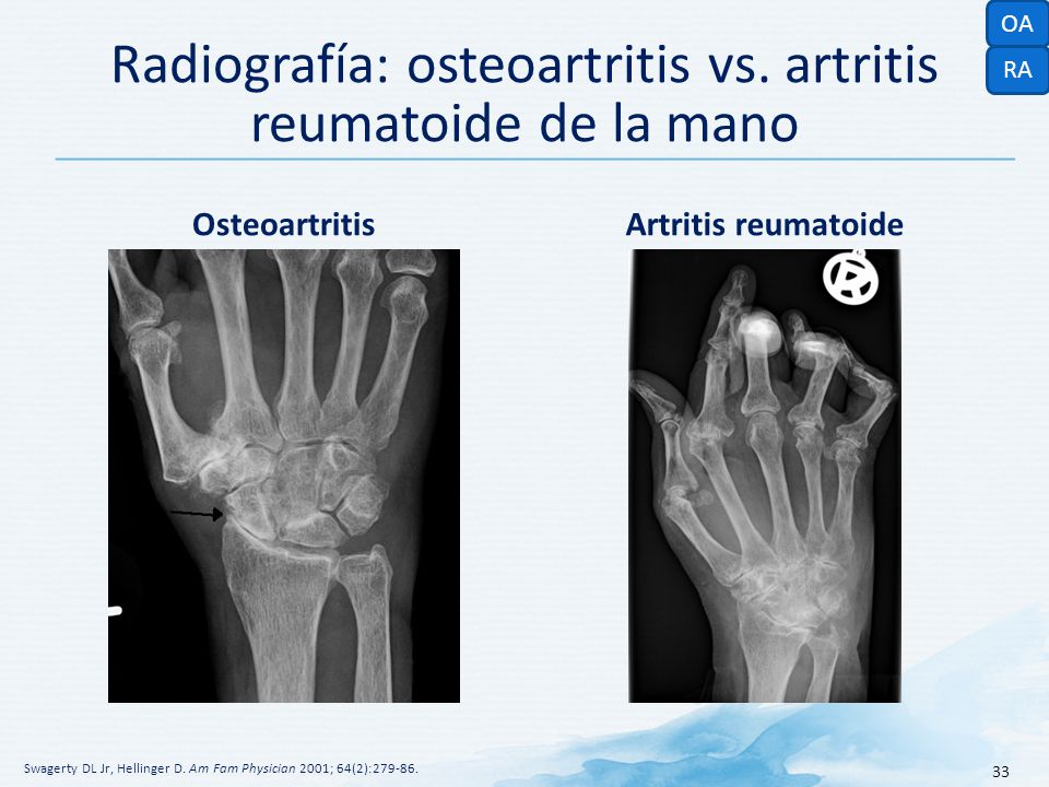 Radiografía: osteoartritis vs. artritis reumatoide de la mano