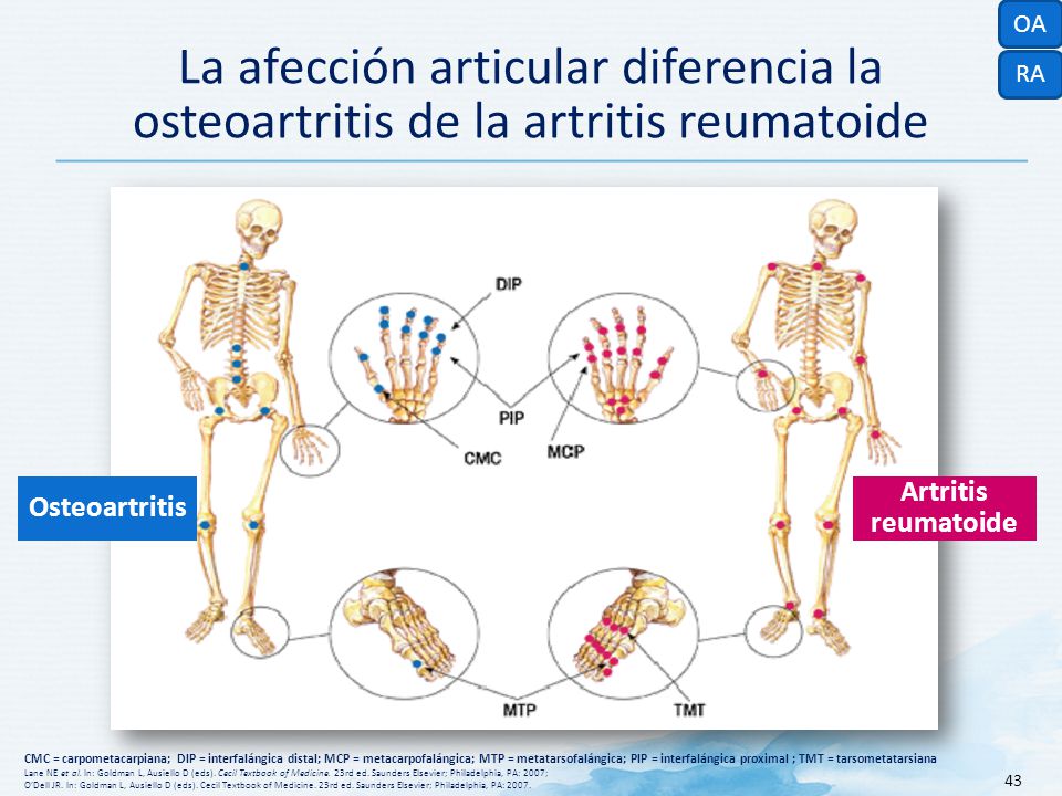 OA La afección articular diferencia la osteoartritis de la artritis reumatoide. RA. Osteoartritis.
