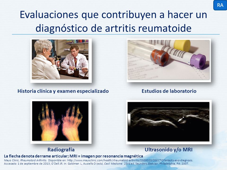 RA Evaluaciones que contribuyen a hacer un diagnóstico de artritis reumatoide. Historia clínica y examen especializado.