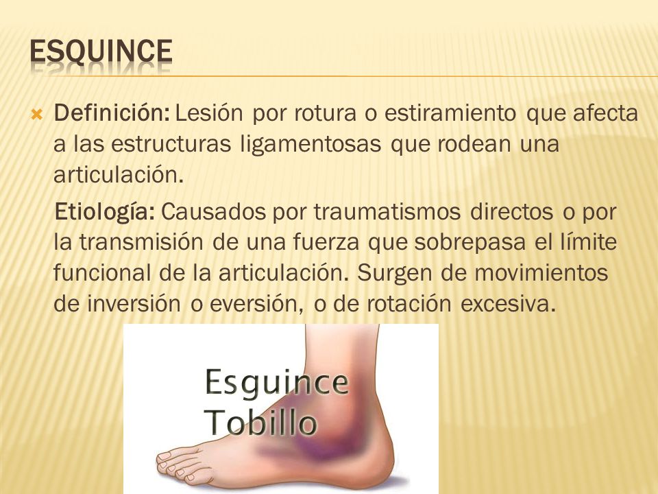 esquince Definición: Lesión por rotura o estiramiento que afecta a las estructuras ligamentosas que rodean una articulación.