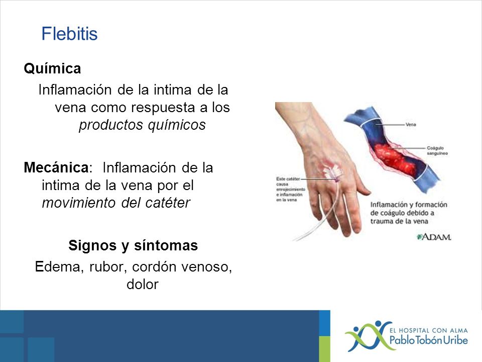 Edema, rubor, cordón venoso, dolor