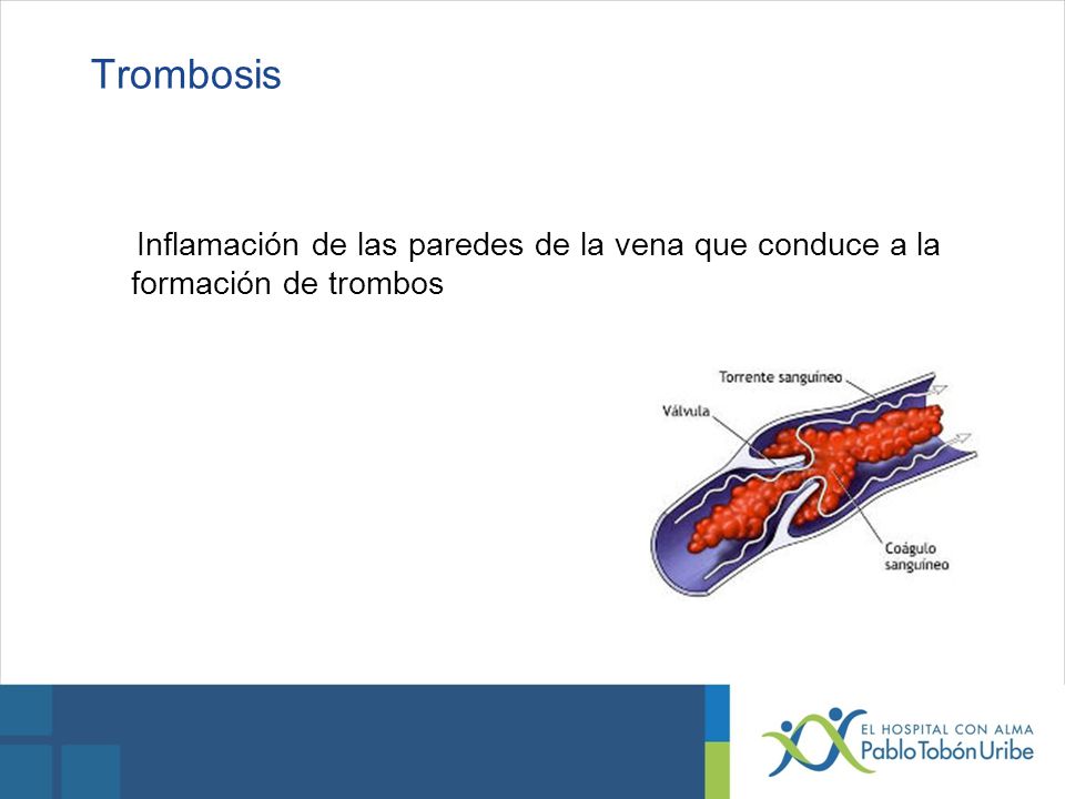 Trombosis Inflamación de las paredes de la vena que conduce a la formación de trombos