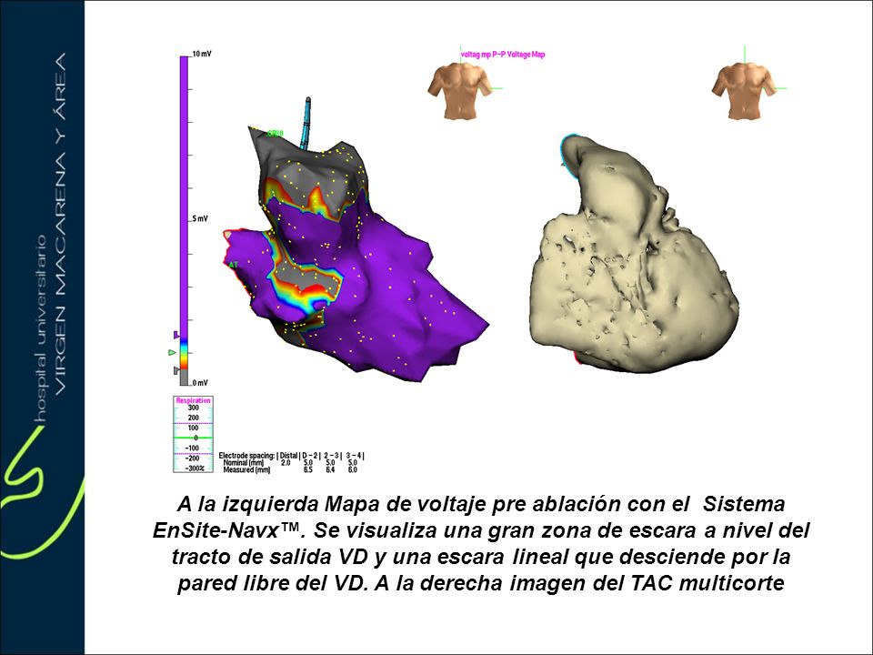 A la izquierda Mapa de voltaje pre ablación con el Sistema EnSite-Navx™.