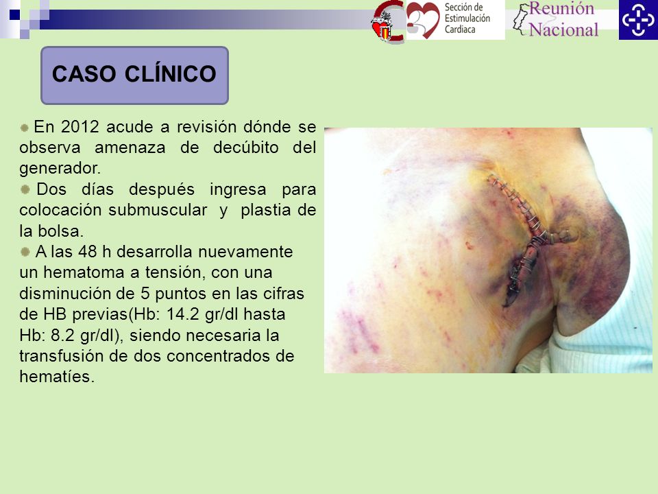 CASO CLÍNICO En 2012 acude a revisión dónde se observa amenaza de decúbito del generador.