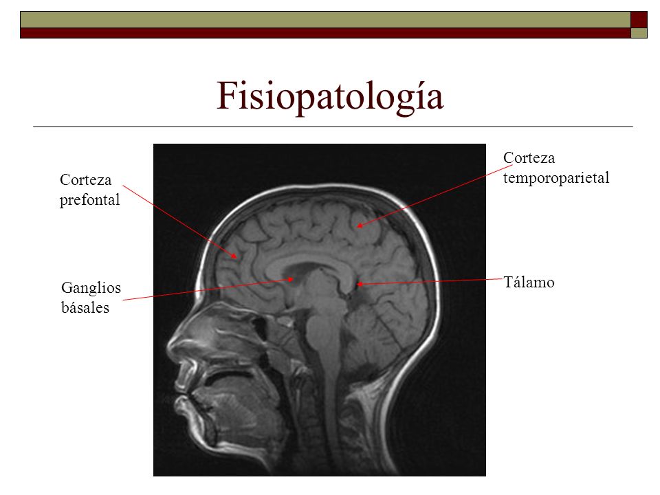 Fisiopatología Corteza temporoparietal Corteza prefontal Tálamo