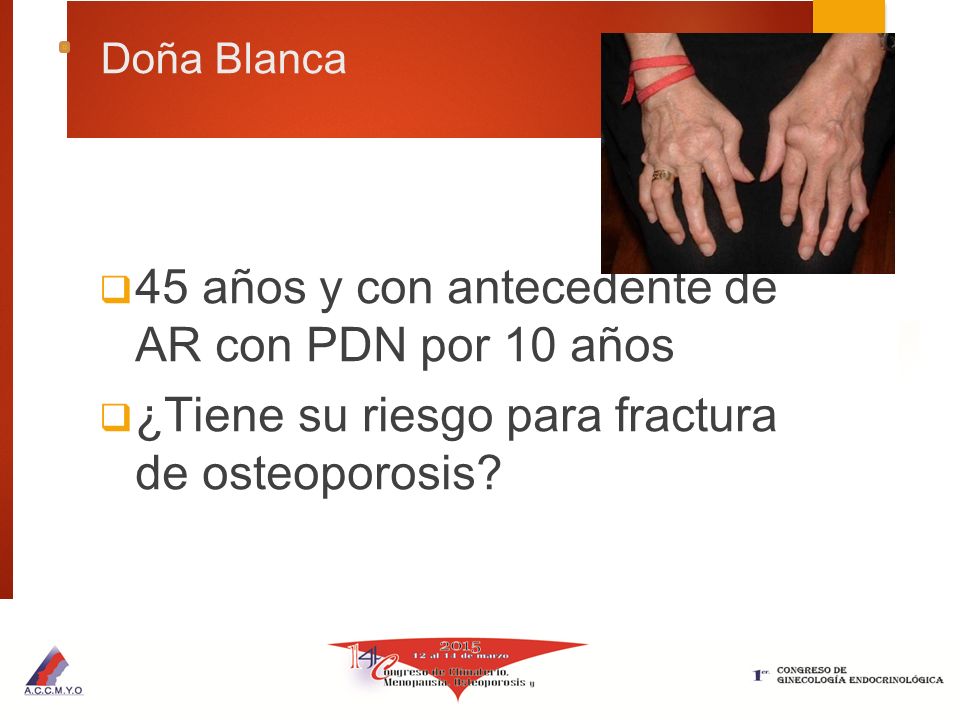 45 años y con antecedente de AR con PDN por 10 años