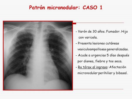 Patrón micronodular: CASO 1