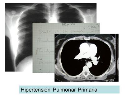 Hipertensión Pulmonar Primaria