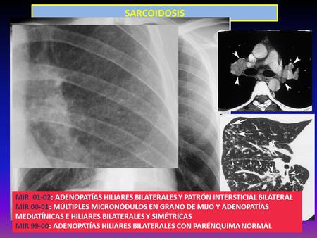 SARCOIDOSIS Figure 5. Pulmonary sarcoidosis in a 24-year-old