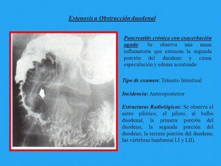 Estenosis u Obstrucción duodenal