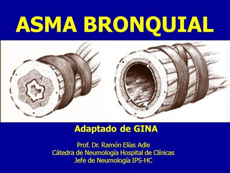 ASMA BRONQUIAL Adaptado de GINA Prof. Dr. Ramón Elías Adle