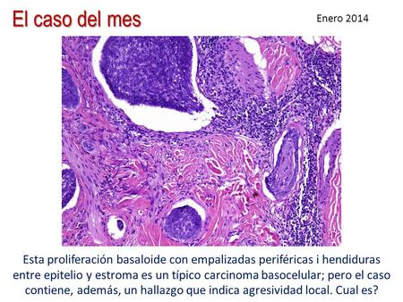 El caso del mes Enero 2014 Esta proliferación basaloide con empalizadas periféricas i hendiduras entre epitelio y estroma es un típico carcinoma basocelular;