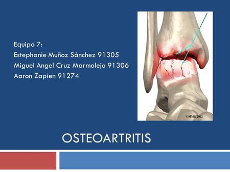 Osteoartritis Equipo 7: Estephanie Muñoz Sánchez 91305