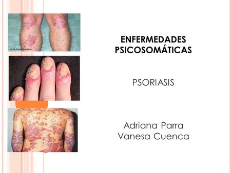 ENFERMEDADES PSICOSOMÁTICAS