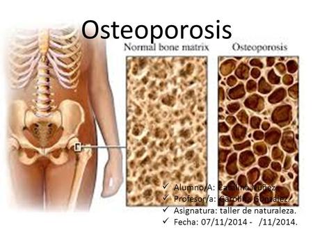 Osteoporosis Alumno/A: Catalina Núñez. Profesor/a: Carolina González.