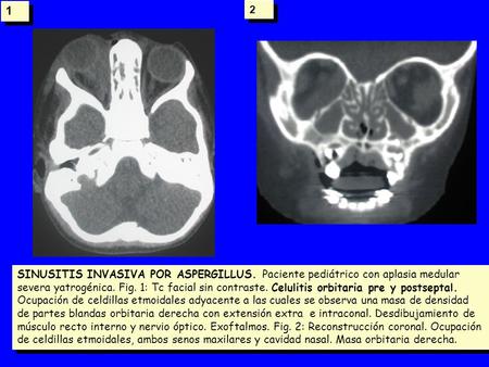 1 2 SINUSITIS INVASIVA POR ASPERGILLUS. Paciente pediátrico con aplasia medular severa yatrogénica. Fig. 1: Tc facial sin contraste. Celulitis orbitaria.
