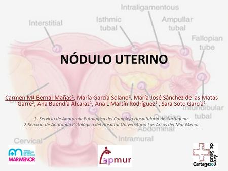 NÓDULO UTERINO Carmen Mª Bernal Mañas1, María García Solano2, María José Sánchez de las Matas Garre2, Ana Buendía Alcaraz1, Ana L Martín Rodríguez1 , Sara.