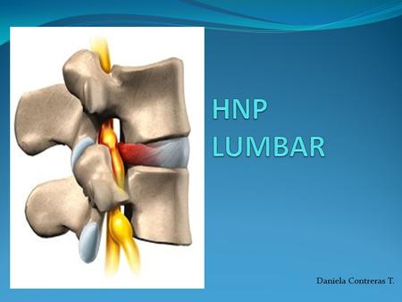 HNP LUMBAR Daniela Contreras T..