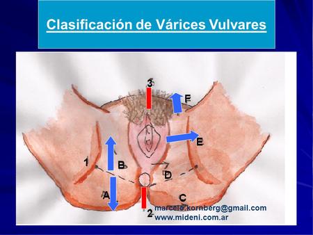 Clasificación de Várices Vulvares