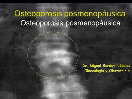 Osteoporosis posmenopáusica