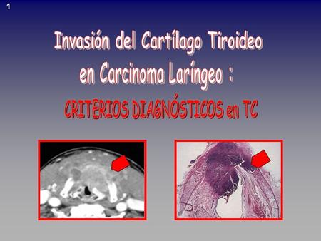 Invasión del Cartílago Tiroideo