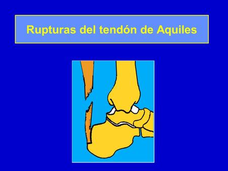 Rupturas del tendón de Aquiles
