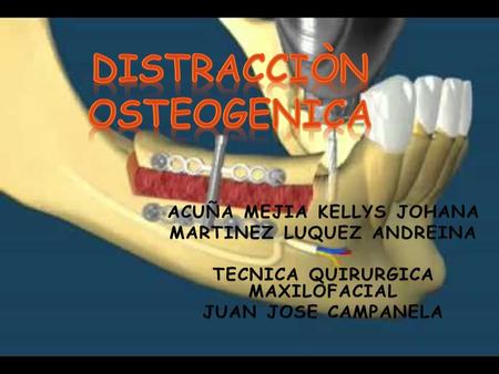 DISTRACCIÒN OSTEOGENICA