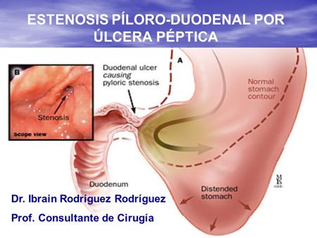 ESTENOSIS PÍLORO-DUODENAL POR ÚLCERA PÉPTICA