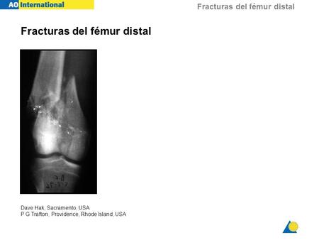 Fracturas del fémur distal